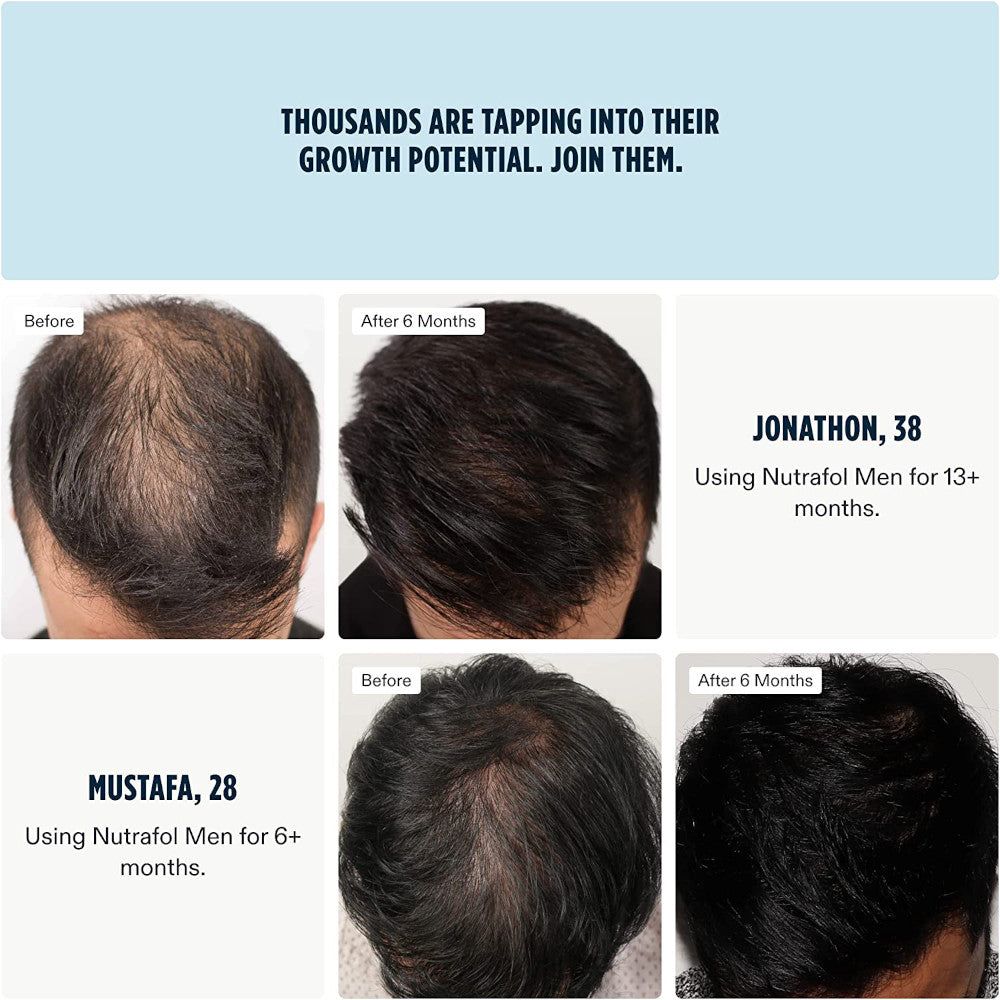 Nutrafol Men Hair Growth Supplement - Before and After.
